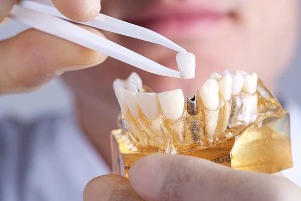 Dental Implants at Dental Associates in Bayonne