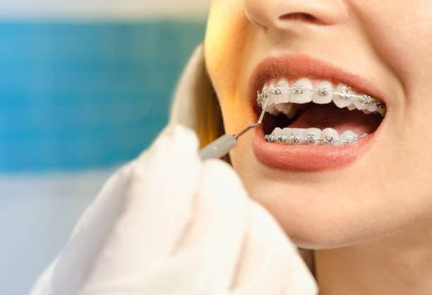 Orthodontics treatment at Dental Associates in Bayonne